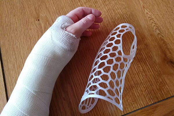 plâtre pour fracture du poignet
