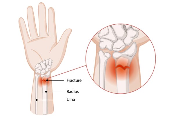 os du poignet avec fracture du radius
