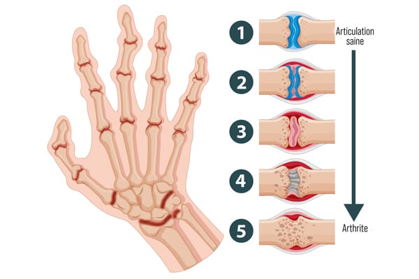 Planche anatomique avec zones d'arthrite sur la main et le poignet