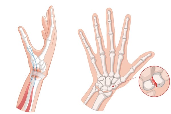 planche anatomique entorse vs fracture du poignet