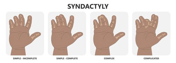 schémas des différentes formes de syndactylie