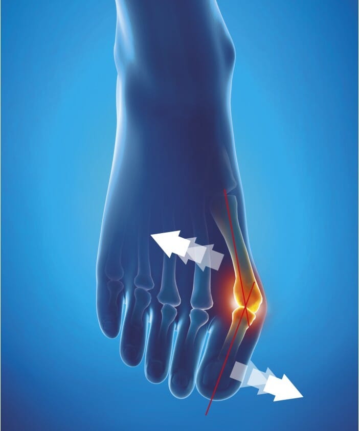 ORTHESE CORRECTIVE SOUPLE DE JOUR EPITACT 2