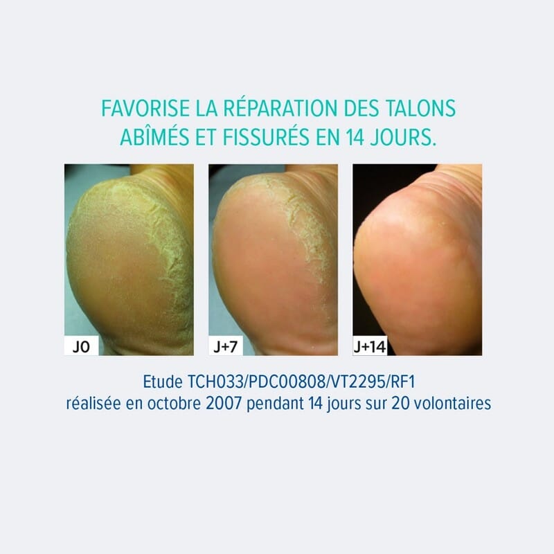 Crème crevasses talonnières 2