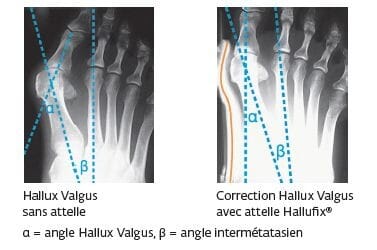 Attelle de correction "Hallux Valgus" 6