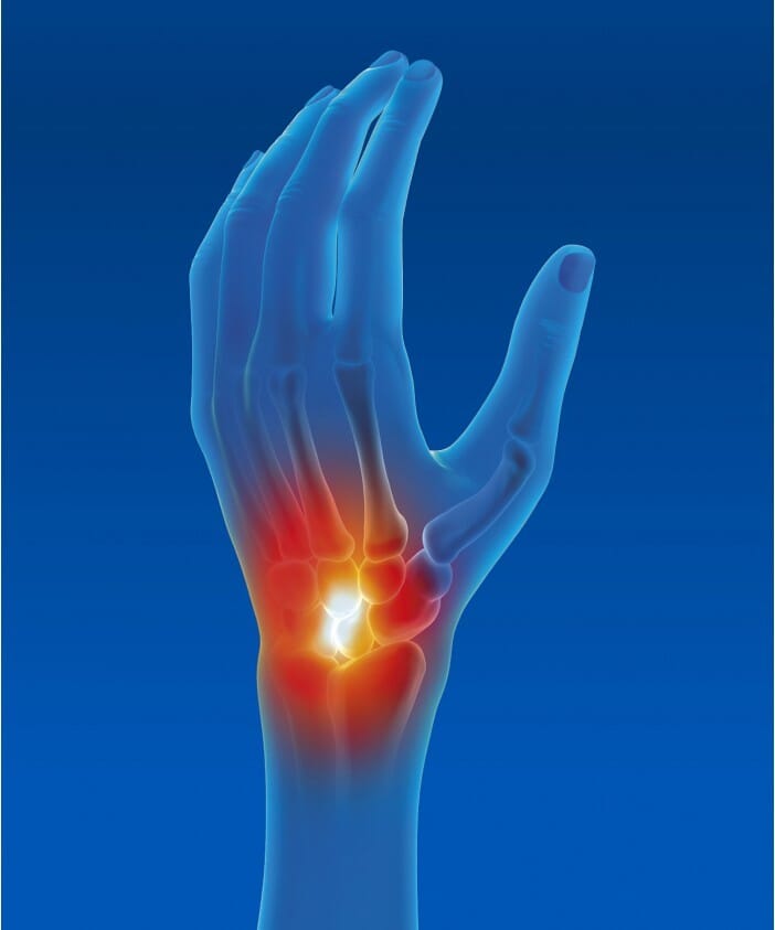 Attelle Poignet-Main d'Immobilisation Epitact 2